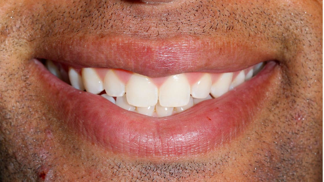 GRANT Porcelain Veneers BEFORE SMILE