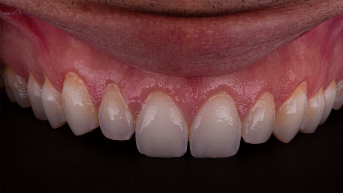 GRANT Porcelain Veneers BEFORE TEETH