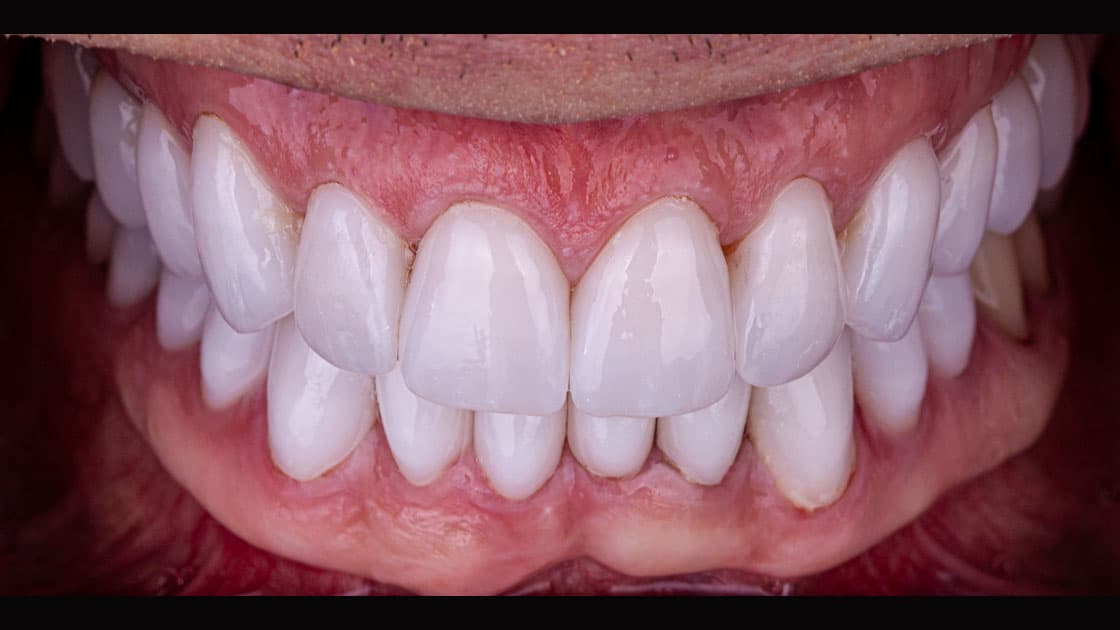 Teeth After Crowns