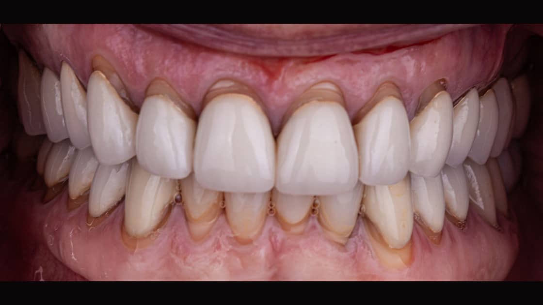 Teeth crowns-before