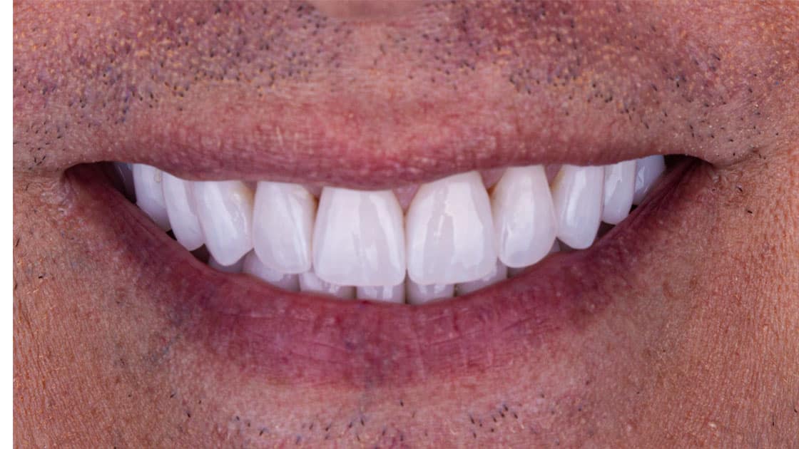 JONATHON Crowns AFTER SMILE