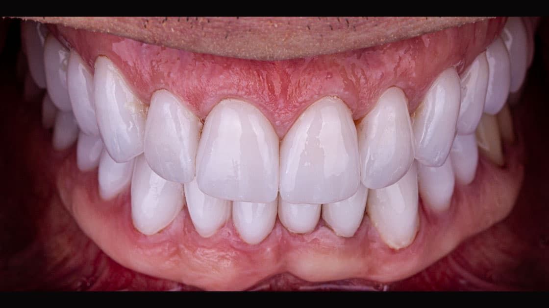JONATHON Crowns AFTER TEETH