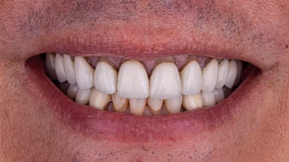 Crowns BEFORE SMILE