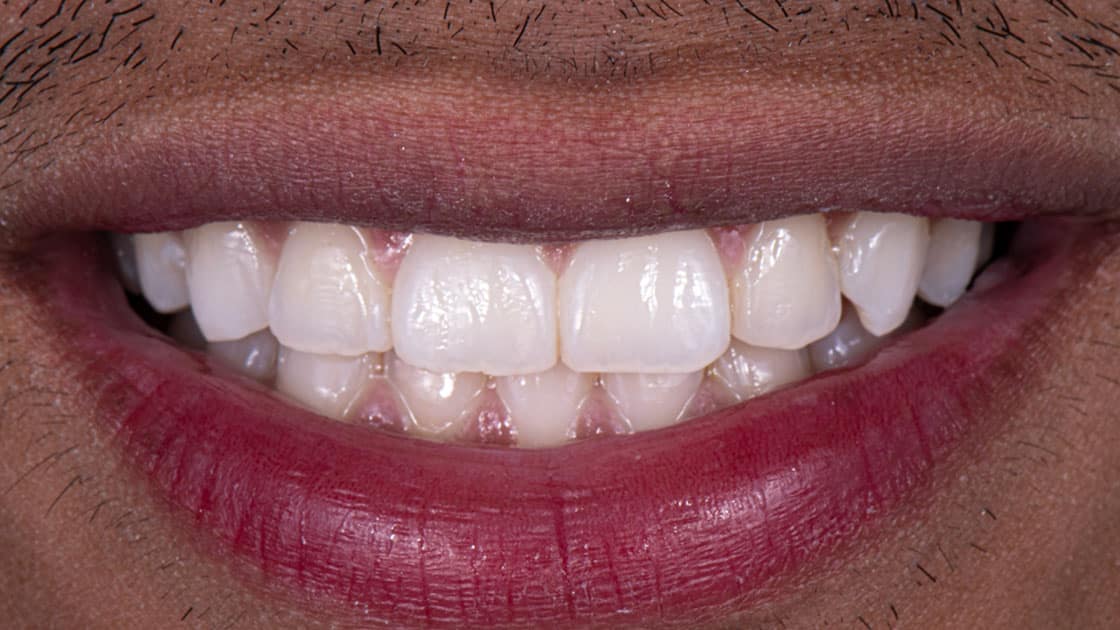 Case 4after smile