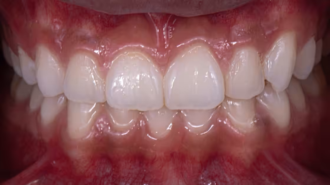 Case 4 after teeth