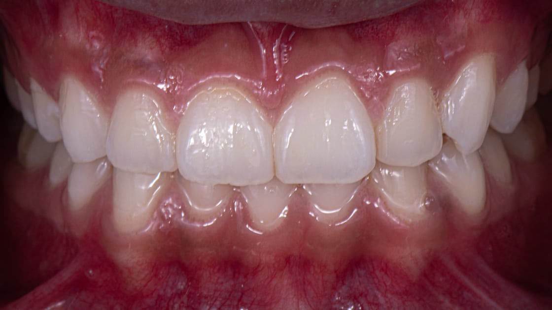 Case 4 after teeth