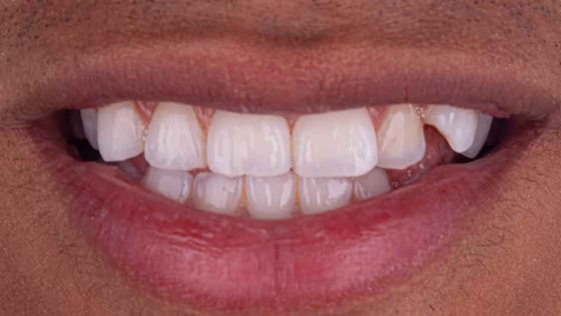 Case 4 before smile