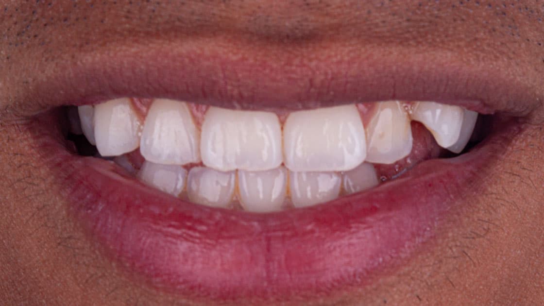 Case 4 before smile