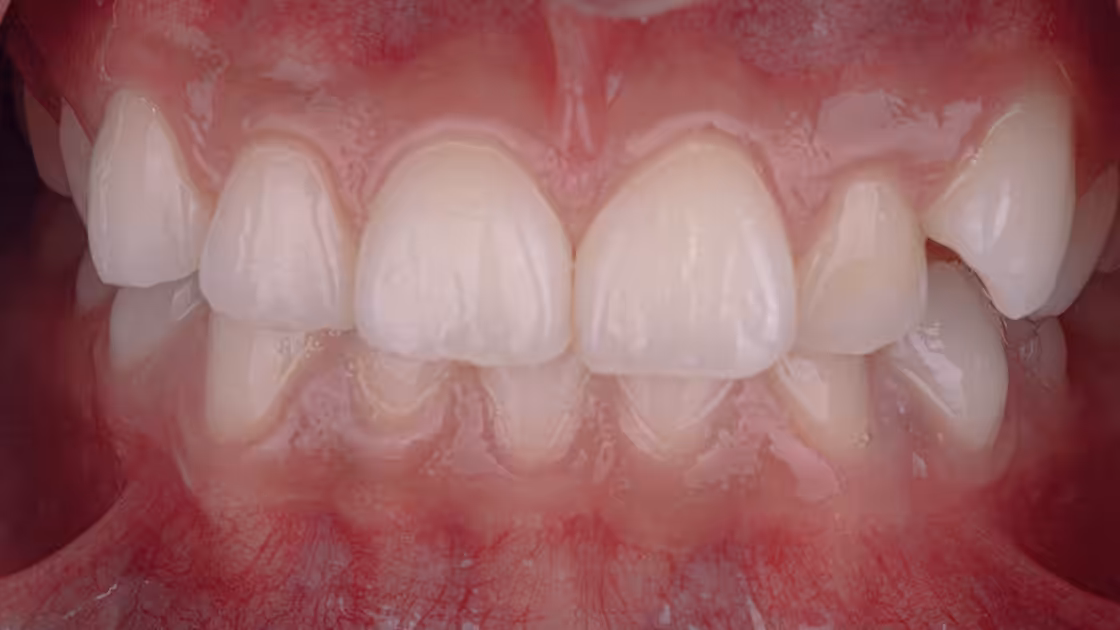 Case 4 before teeth