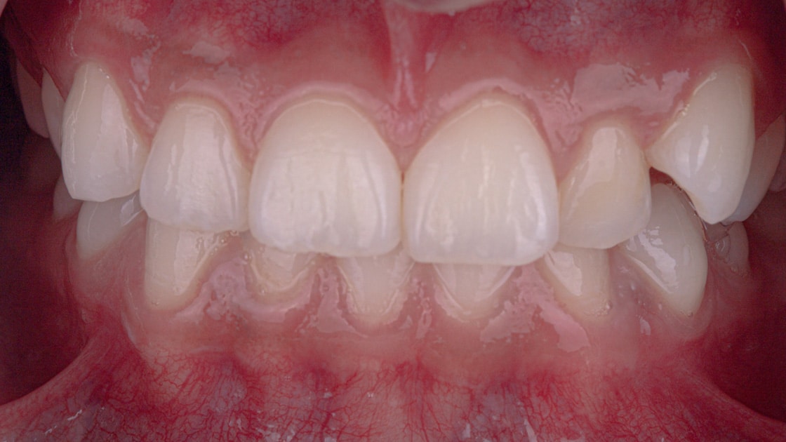 Case 4 before teeth