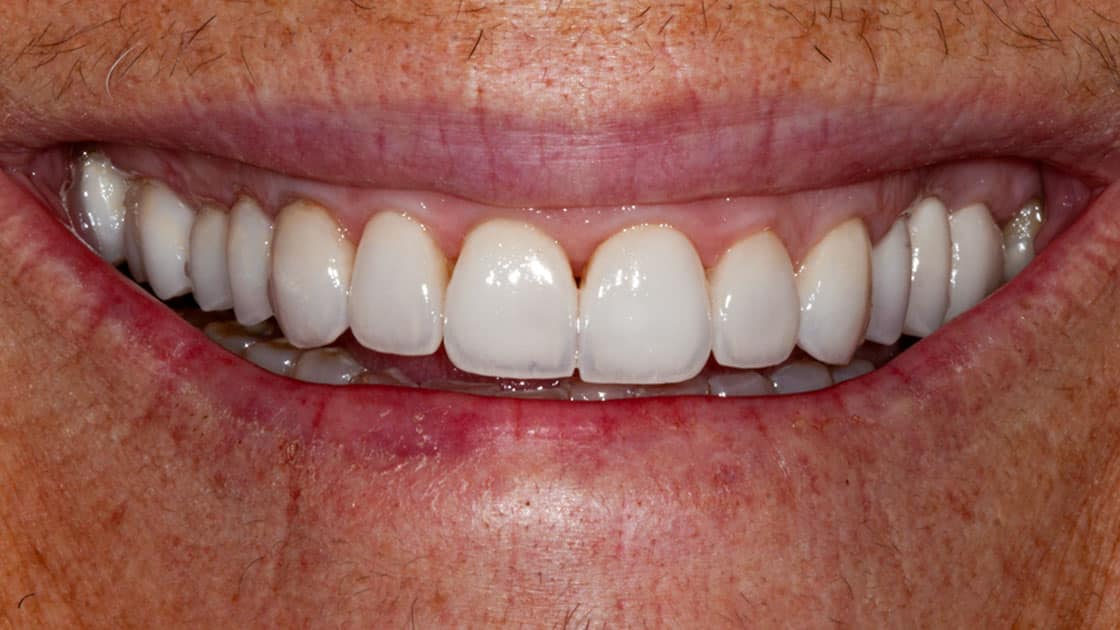 KRISSY Porcelain Veneers AFTER Smile