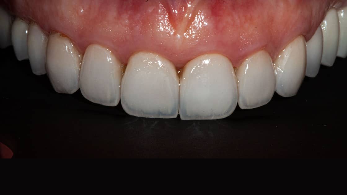 KRISSY Porcelain Veneers AFTER TEETH