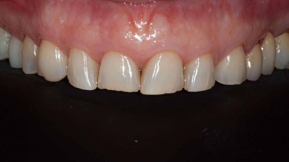 KRISSY Porcelain Veneers BEFORE TEETH