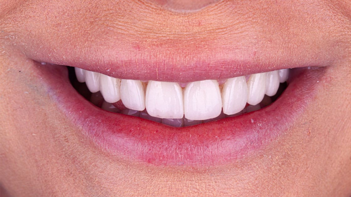 KRISTINA Porcelain Veneers AFTER SMILE