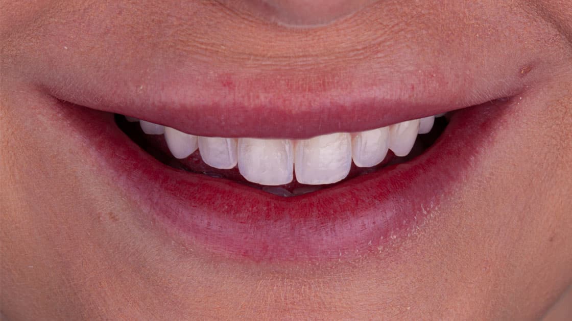 KRISTINA Porcelain Veneers BEFORE SMILE