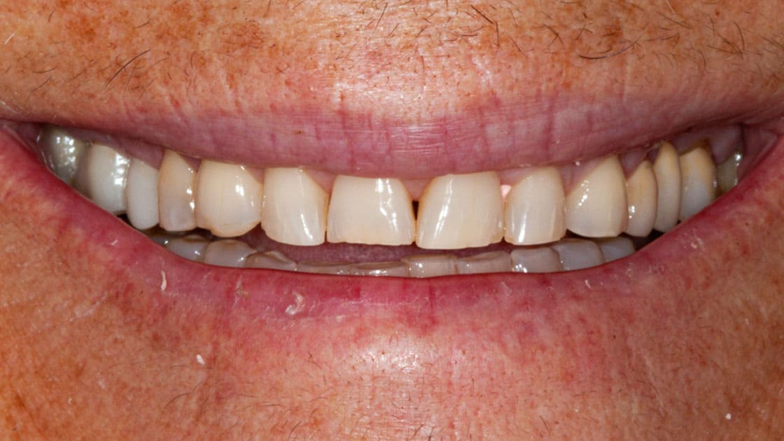 Case 4 smile crowns-before