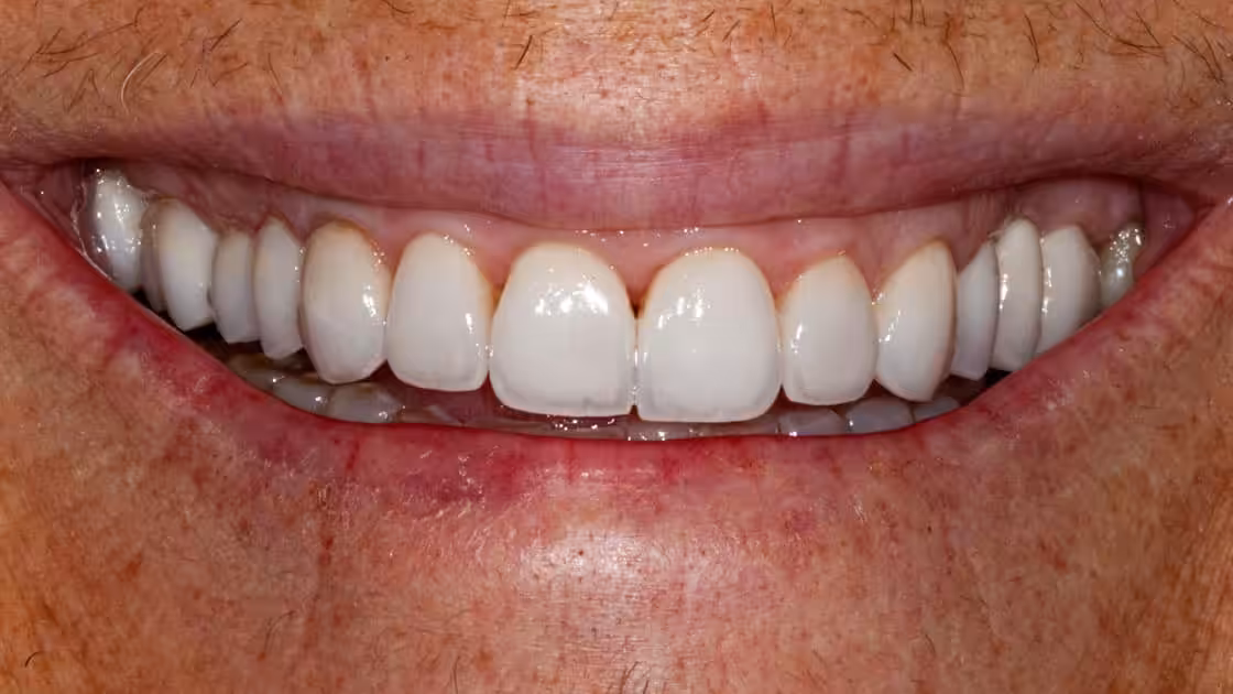 Case 4 Smile After