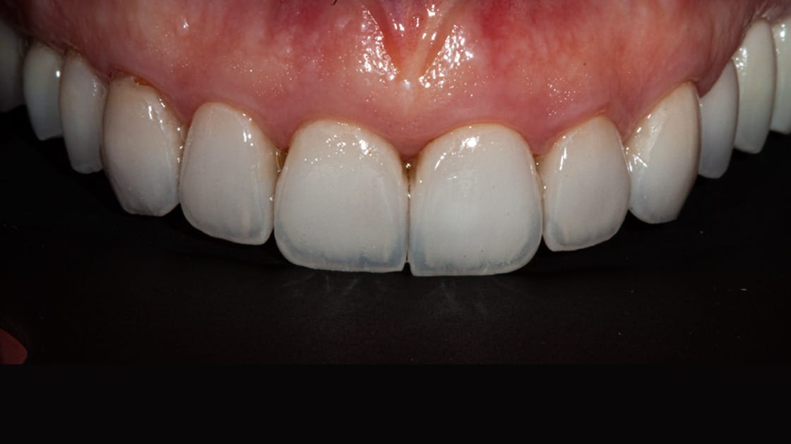 Case 4 Teeth After Crowns