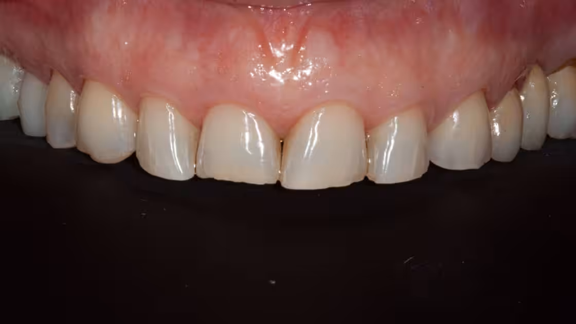 Krissy teeth crowns