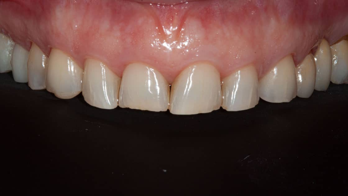 Case 4 teeth before crowns