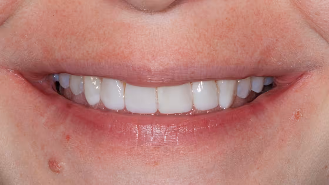 Composite Veneers-AFTER-SMILE