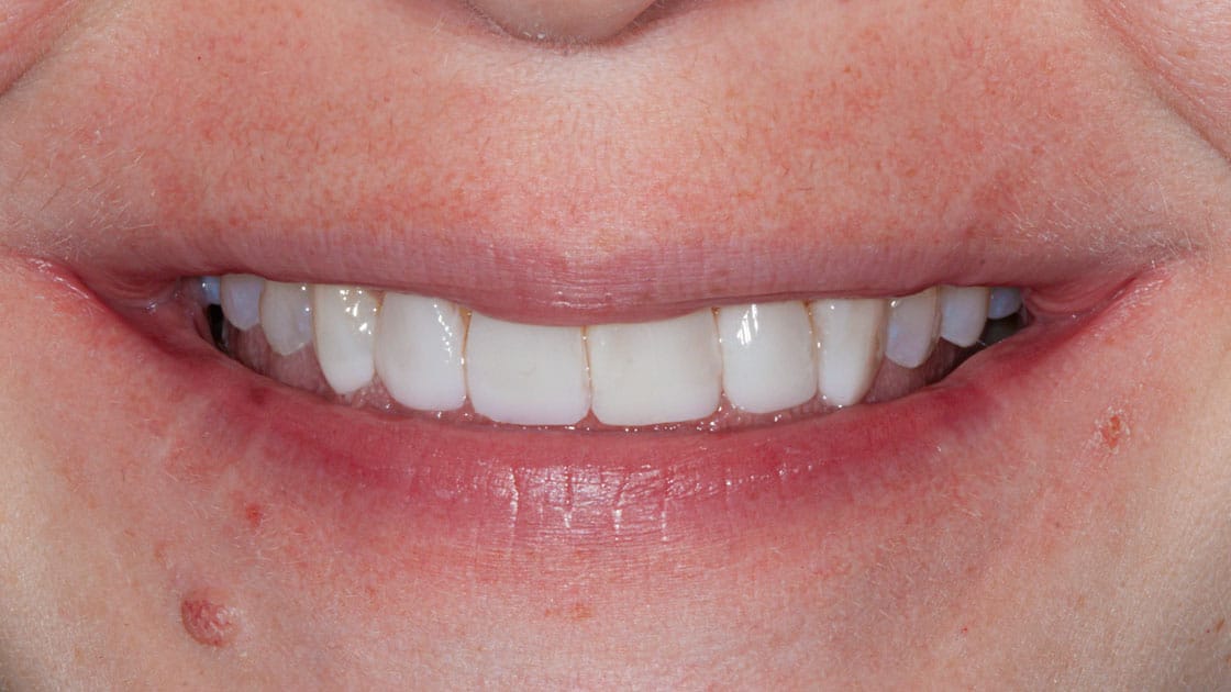 Composite Veneers-AFTER-SMILE