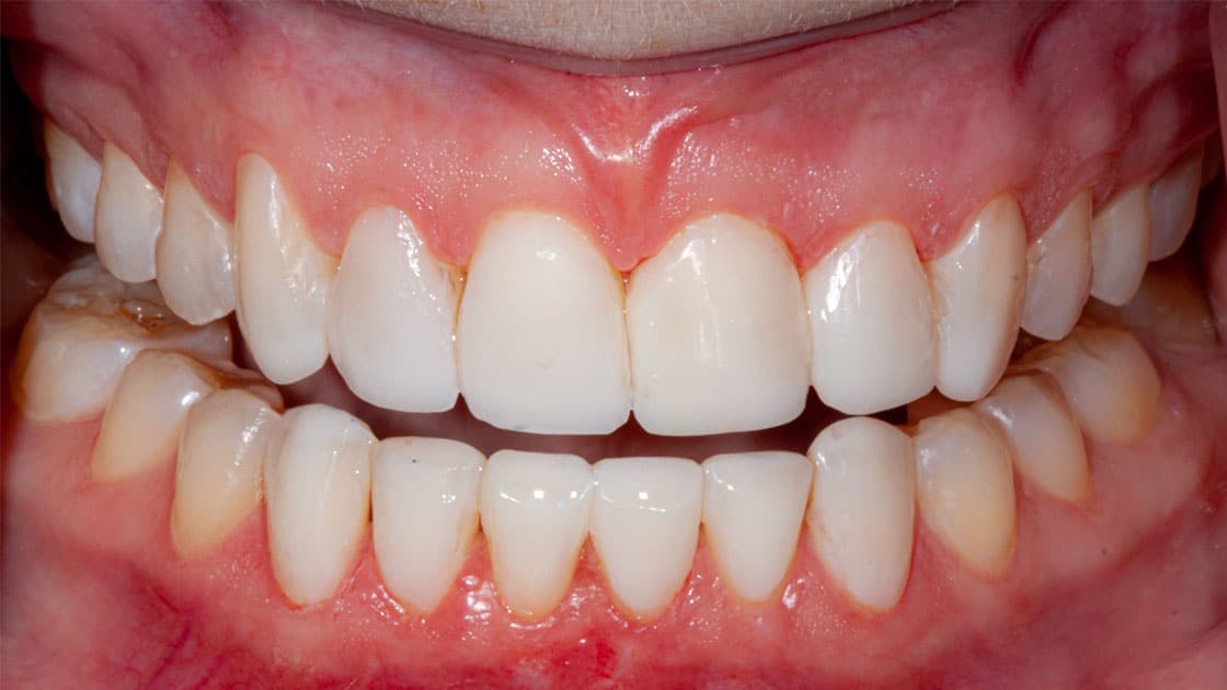 LAUREN-Composite Veneers-AFTER-TEETH