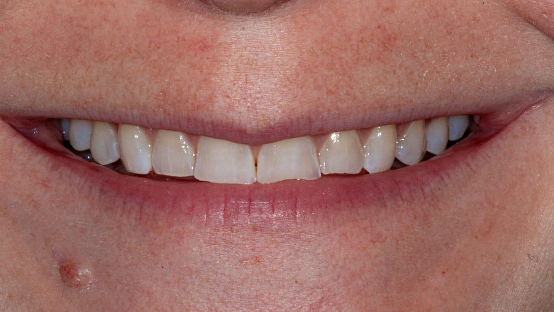 Composite Veneers-BEFORE-SMILE