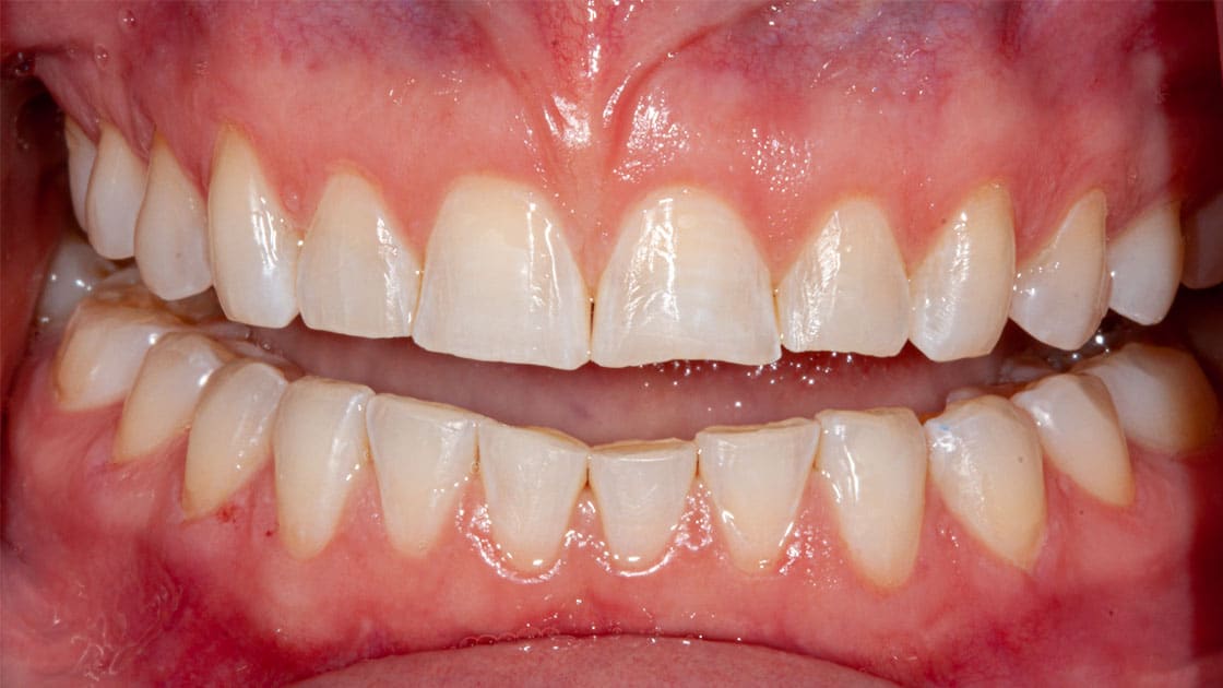 LAUREN-Composite Veneers-BEFORE-TEETH