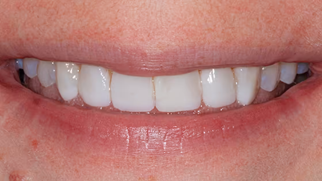 Case 3 after smile