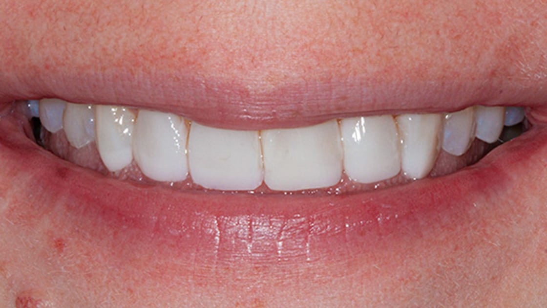 Case 7 after smile