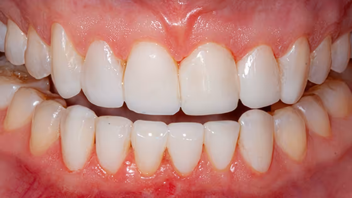 Case 3 after teeth