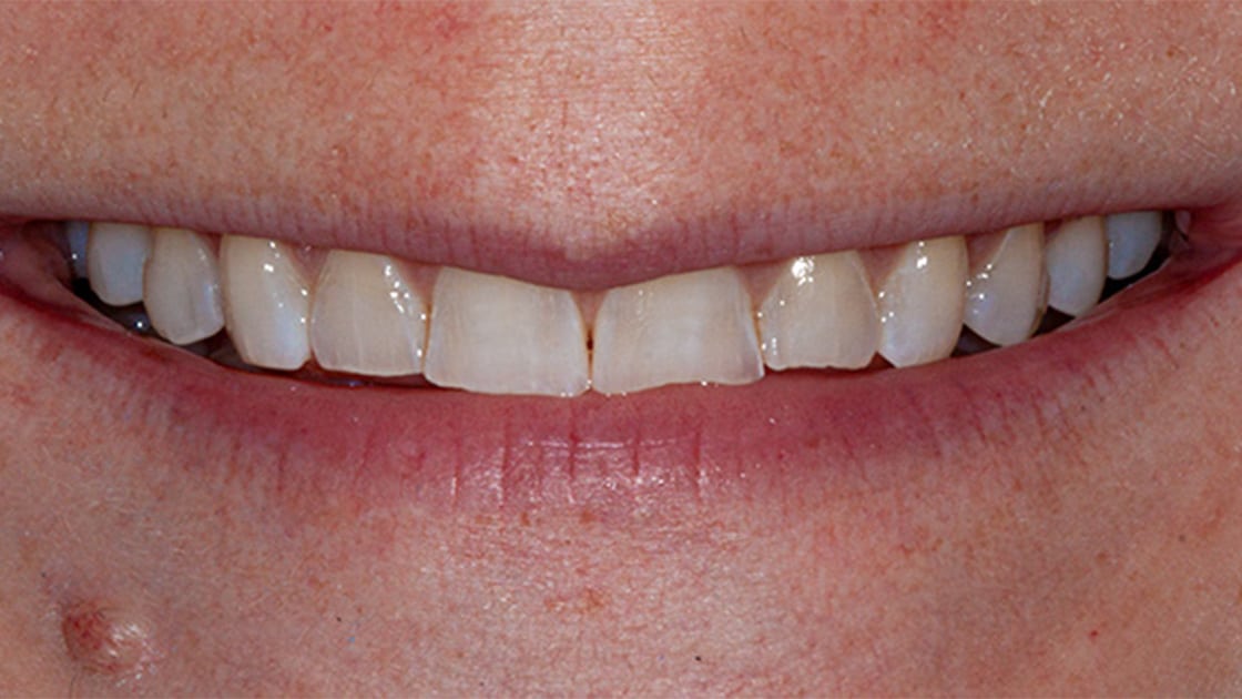 Case 7 before smile