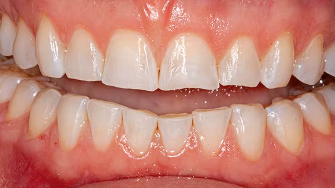 Case 3 before teeth
