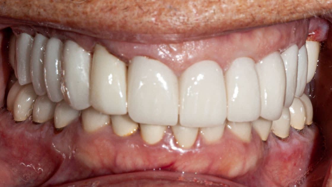 MAMA Porcelain Crowns AFTER TEETH