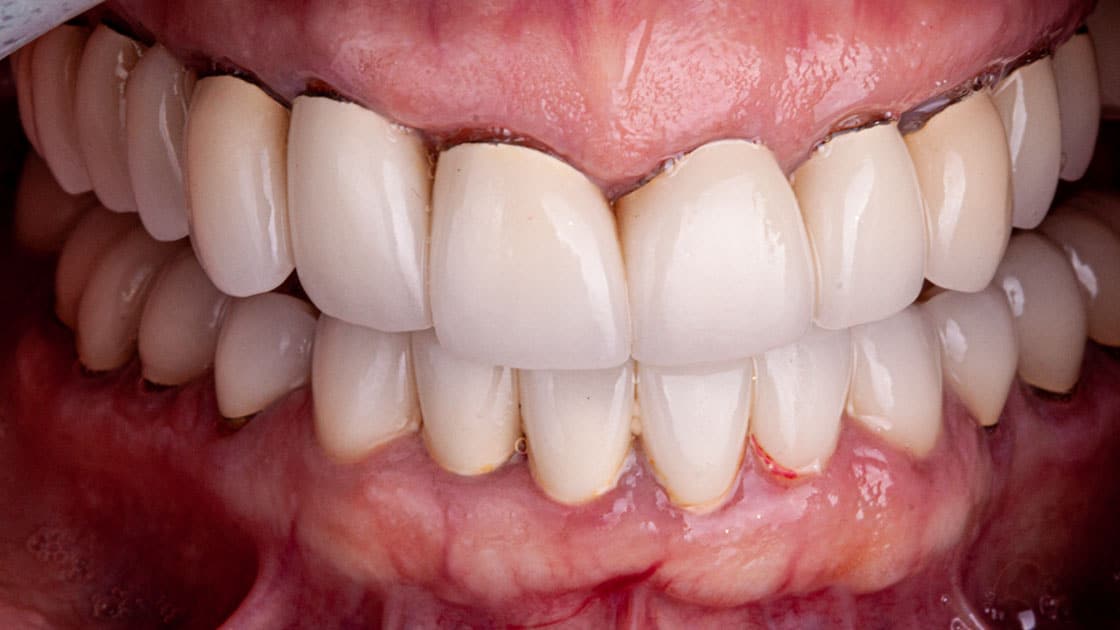 MAMA Porcelain Crowns BEFORE TEETH