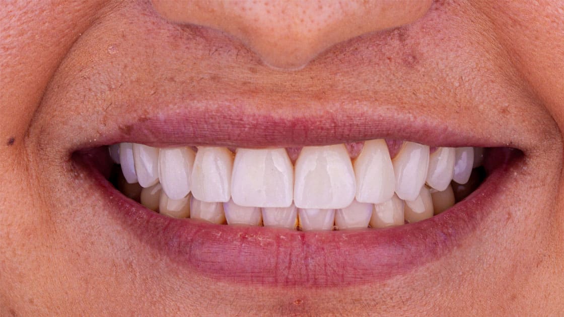 MARIBEL Porcelain Veneers AFTER SMILE