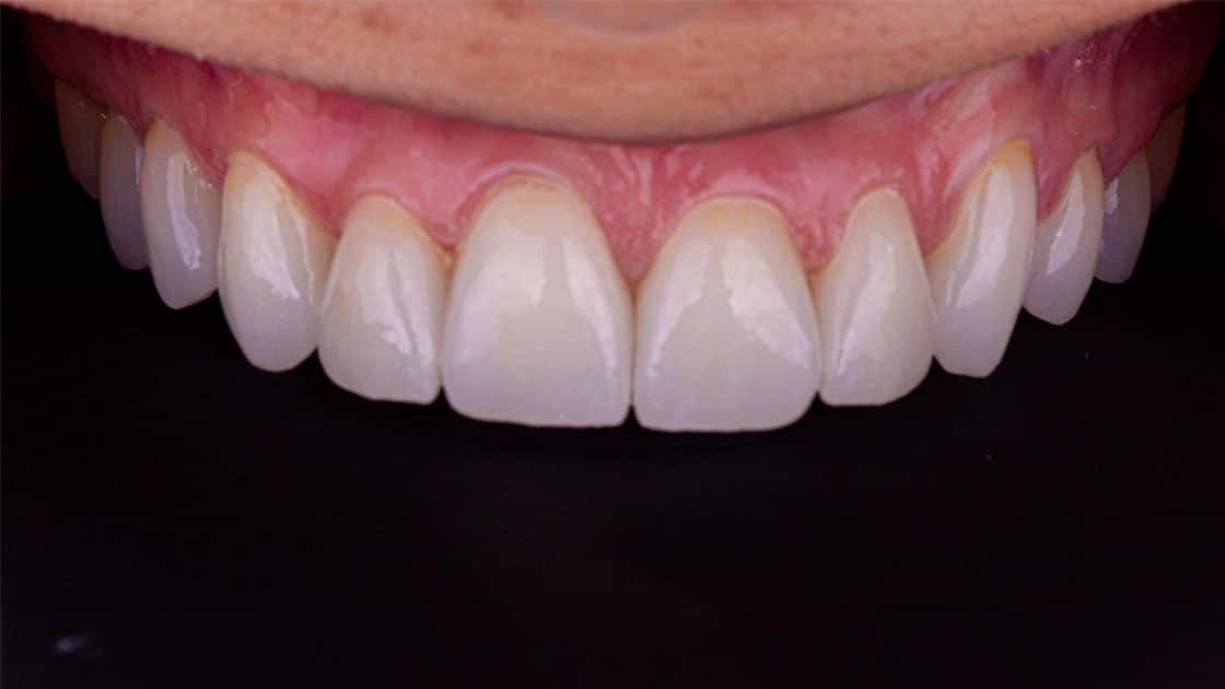 MARIBEL Porcelain Veneers AFTER TEETH