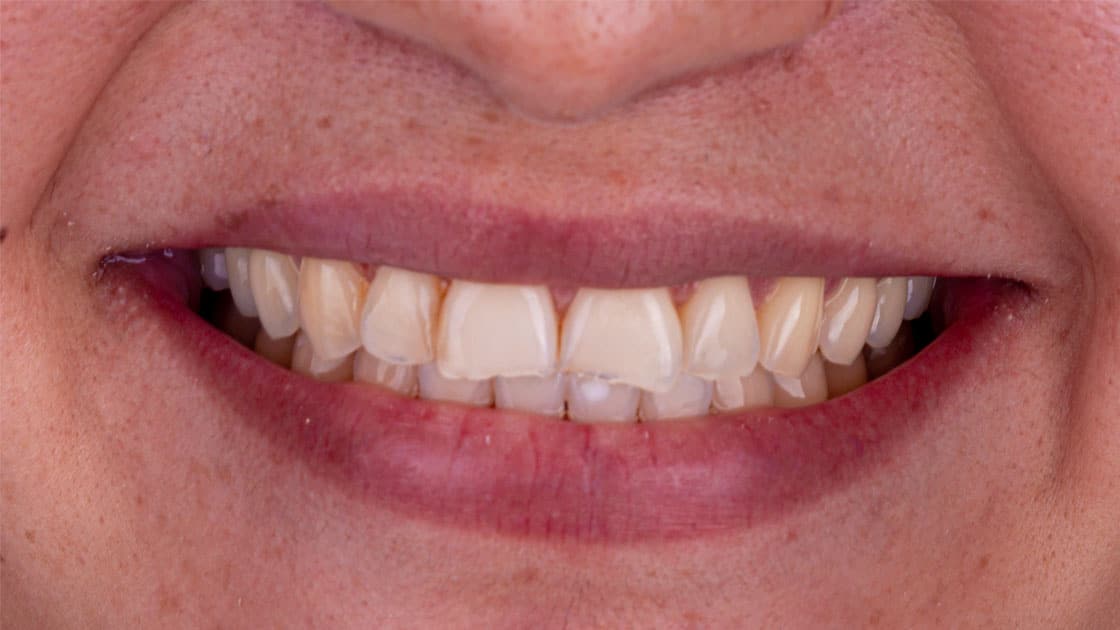 MARIBEL Porcelain Veneers BEFORE SMILE