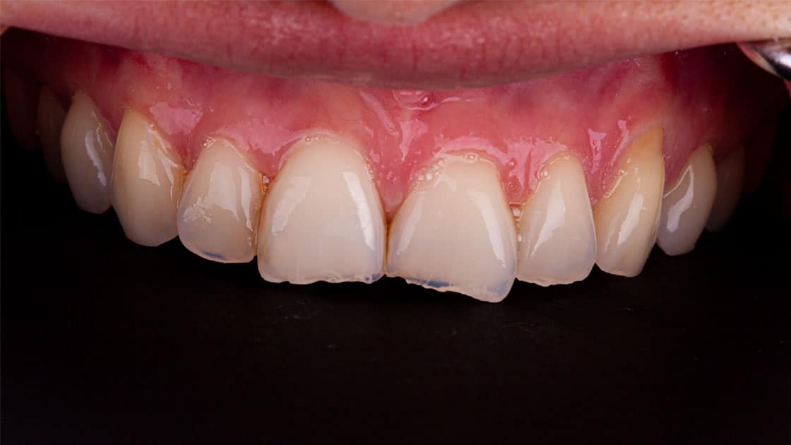MARIBEL Porcelain Veneers BEFORE TEETH