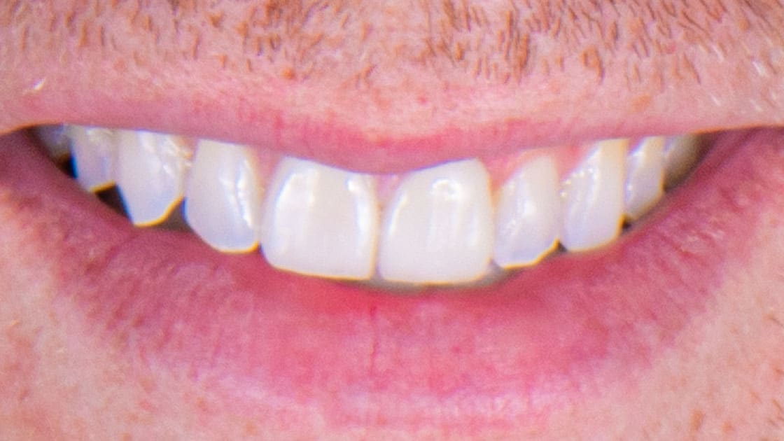 NOAH Porcelain Crowns AFTER SMILE