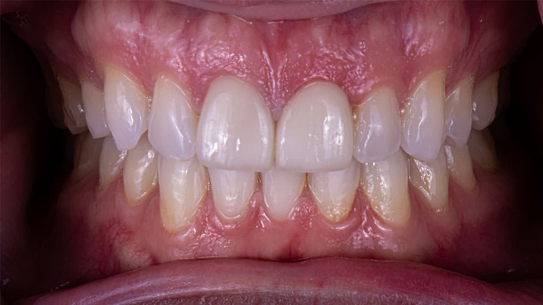 NOAH Porcelain Crowns AFTER TEETH
