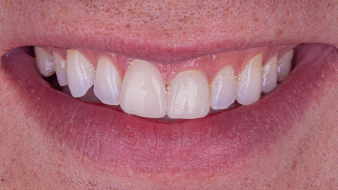 NOAH Porcelain Crowns BEFORE SMILE