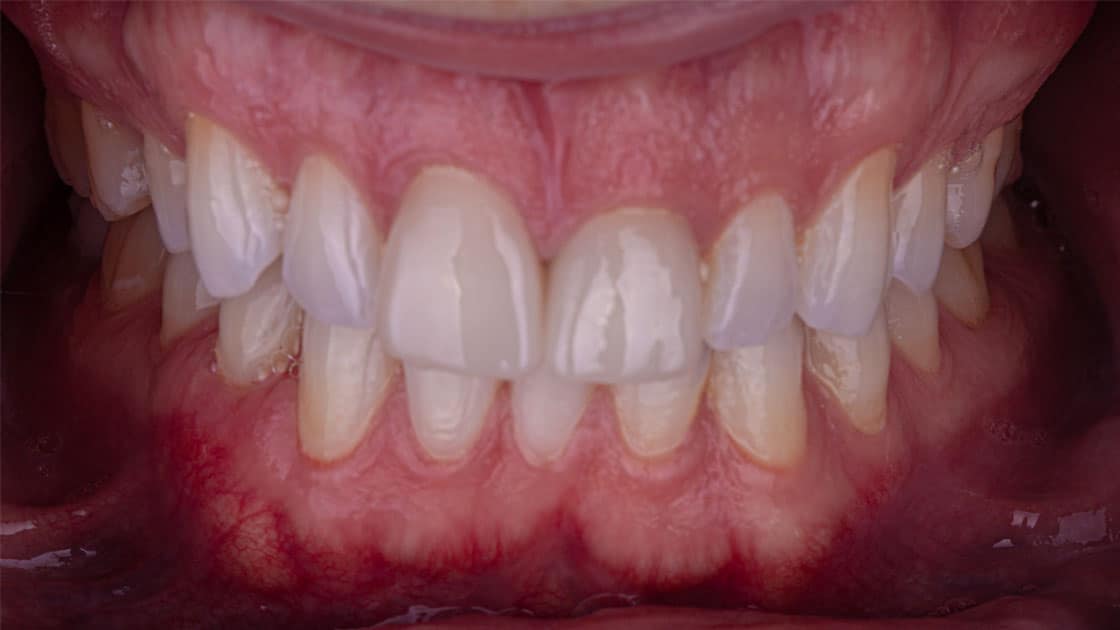 NOAH Porcelain Crowns BEFORE TEETH
