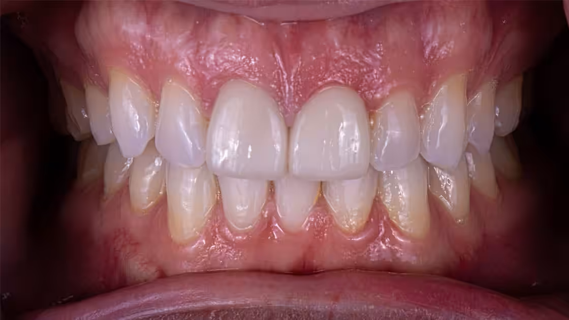 Case 1 TEETH After Crowns