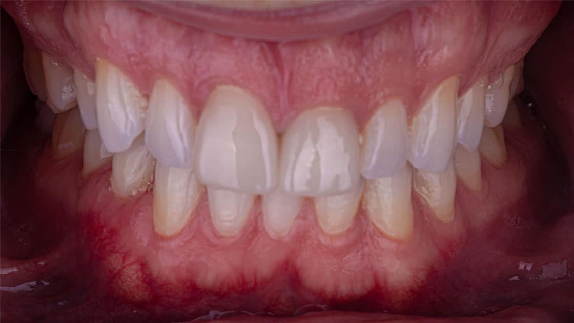 Case 1 before TEETH Crowns