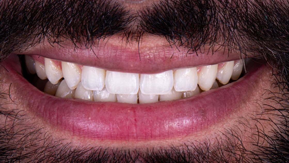 SALEM-Invisalign-AFTER-SMILE