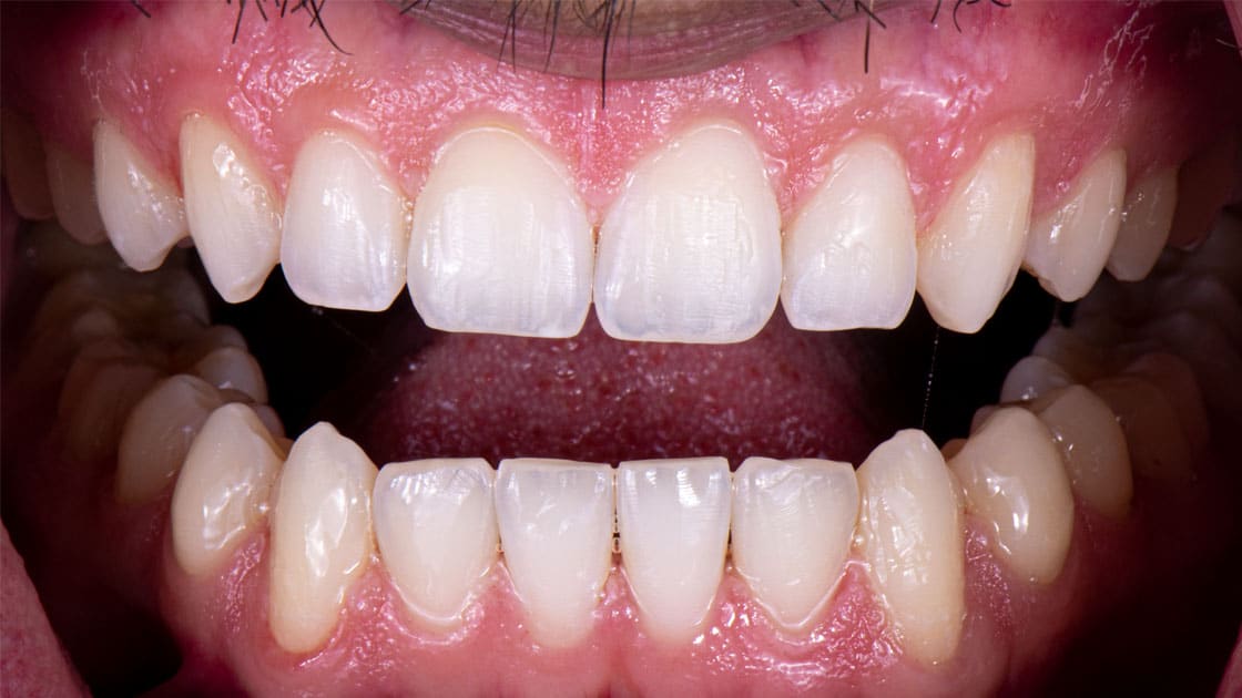 SALEM-Invisalign-AFTER-TEETH
