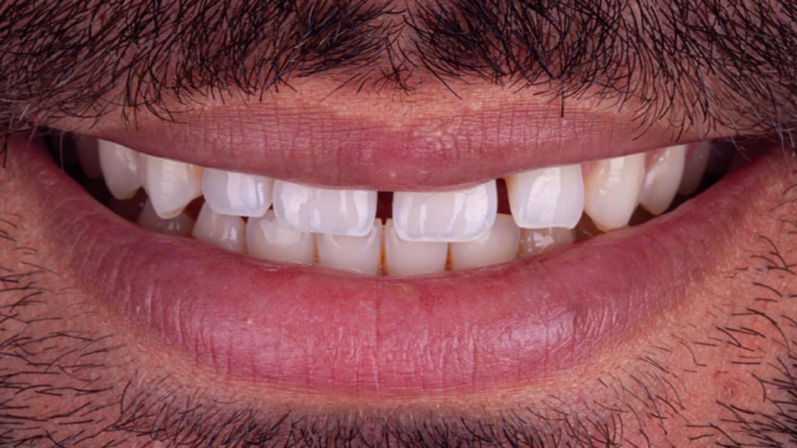 SALEM-Invisalign-BEFORE-SMILE