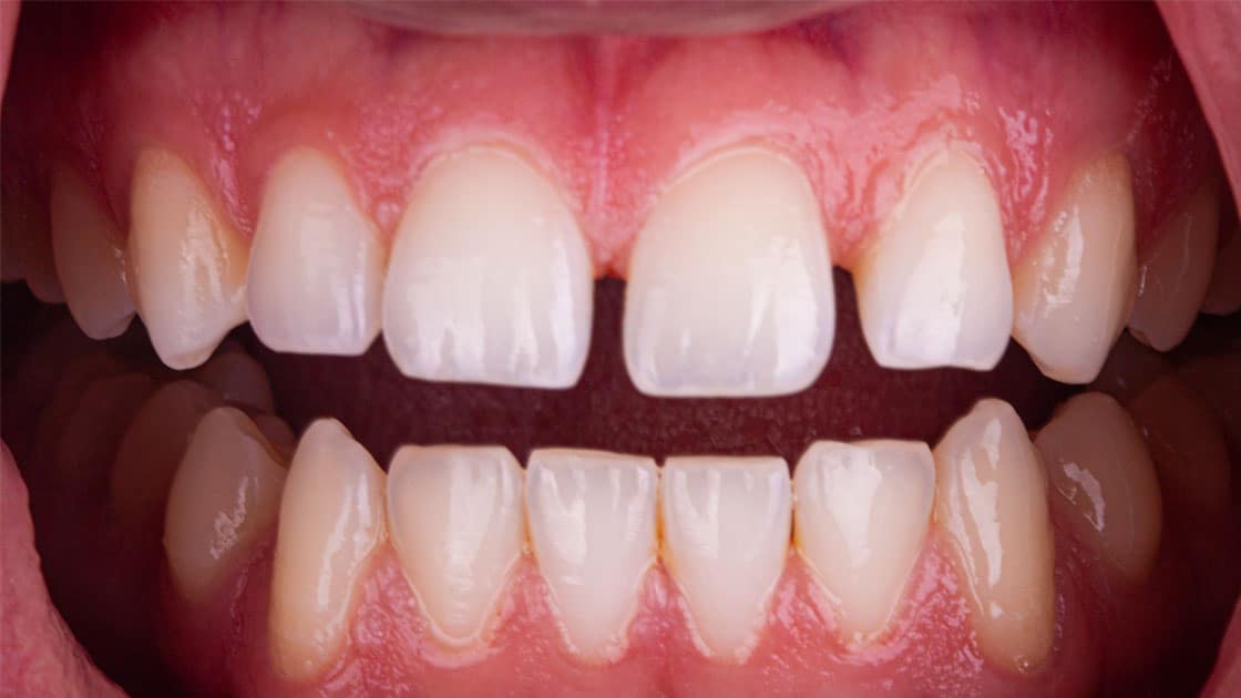 SALEM-Invisalign-BEFORE-TEETH